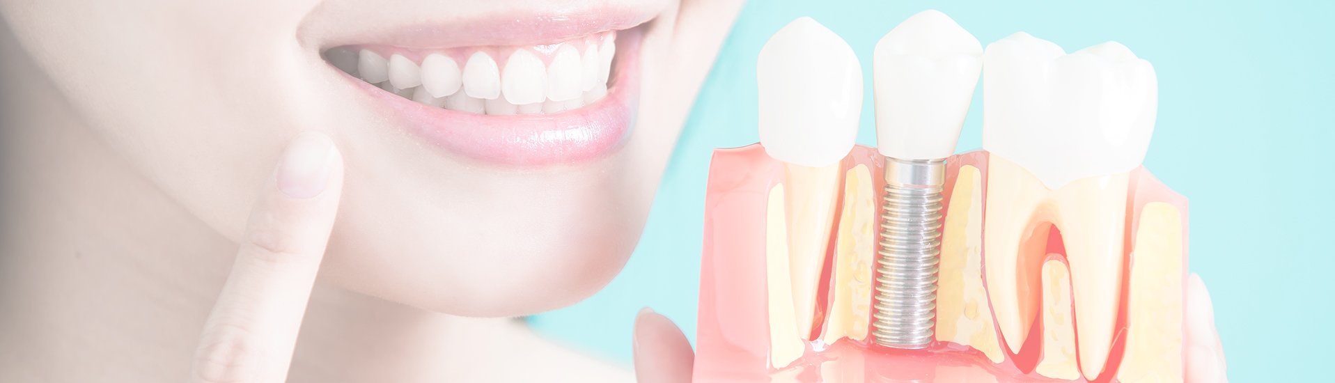 dental-implants-banner